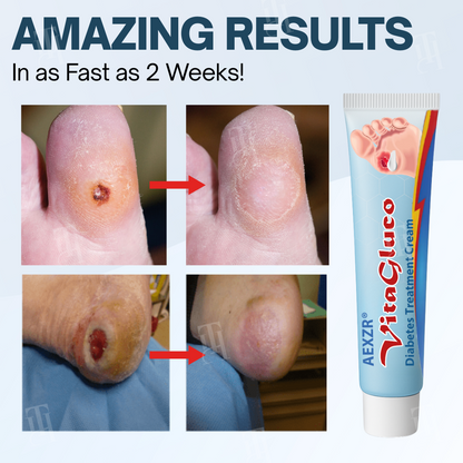 Clinically Proven: 95% Faster Wound Healing with AEXZR® VitaGluco Diabetes Treatment Cream